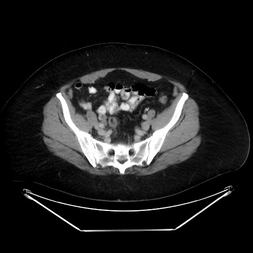 File:Colonic intussusception due to adenocarcinoma (Radiopaedia 86828-102987 A 117).jpg