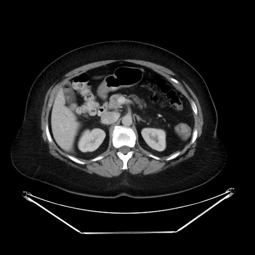File:Colonic intussusception due to adenocarcinoma (Radiopaedia 86828-102987 A 53).jpg
