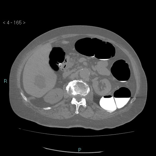 File:Colonic lipomas (Radiopaedia 49137-54244 Axial bone window 73).jpg