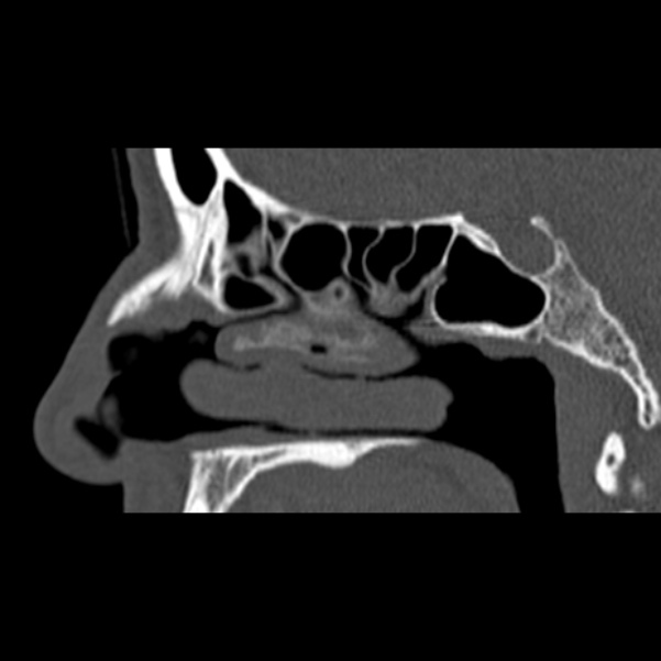 Nasal septal perforation (Radiopaedia 25030-25289 Sagittal bone window 22).jpg