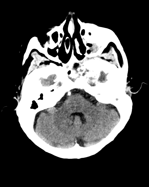 Nasopharyngeal carcinoma with cerebral abscess (Radiopaedia 43018-46275 Axial C+ delayed 14).png