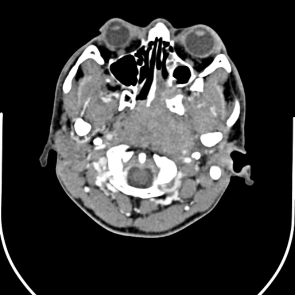 Nasopharyngeal carcinoma with skull base invasion (Radiopaedia 53415-59705 A 37).jpg