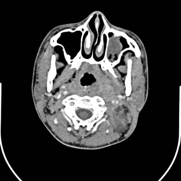 File:Nasopharyngeal carcinoma with skull base invasion (Radiopaedia 53415-59705 A 66).jpg