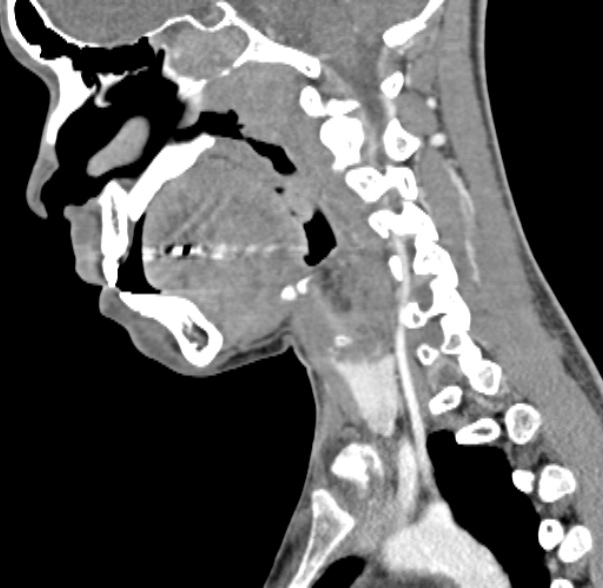 Nasopharyngeal carcinoma with skull base invasion (Radiopaedia 53415-59705 C 39).jpg