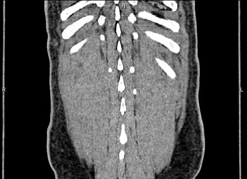 Necrotizing pancreatitis (Radiopaedia 87796-104248 F 64).jpg