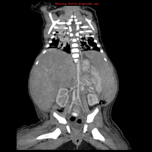 File:Neonatal neuroblastoma (Radiopaedia 9564-10223 B 85).jpg