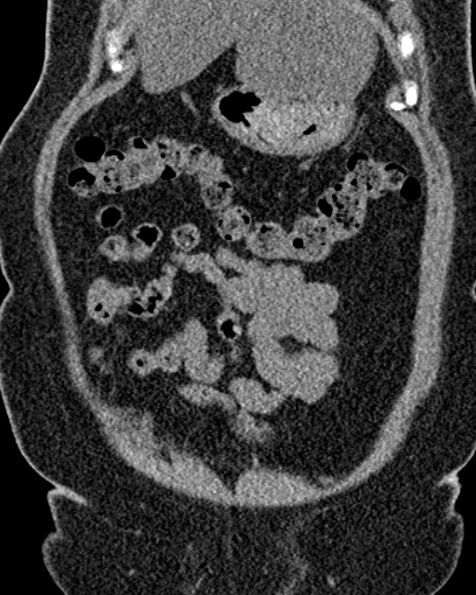 File:Nephrostomy for urosepsis (Radiopaedia 26180-26330 non-contrast 20).jpg