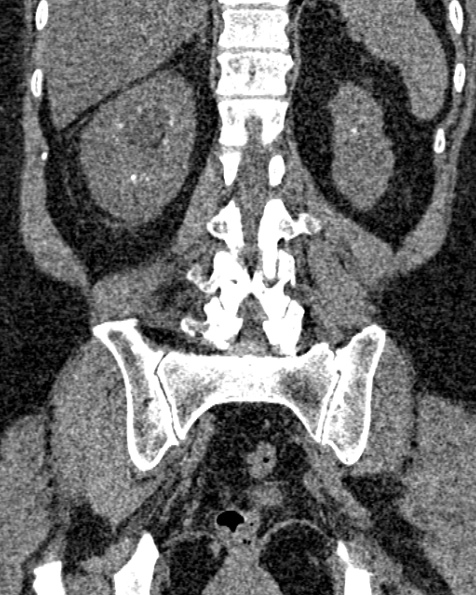 File:Nephrostomy for urosepsis (Radiopaedia 26180-26330 non-contrast 64).jpg