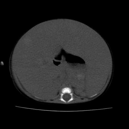 File:Neuroblastoma (Radiopaedia 20876-20799 Axial non-contrast 11).jpg