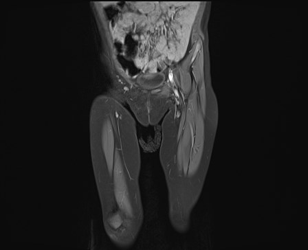File:Neuroblastoma with bone metastases (Radiopaedia 67080-76414 E 5).jpg