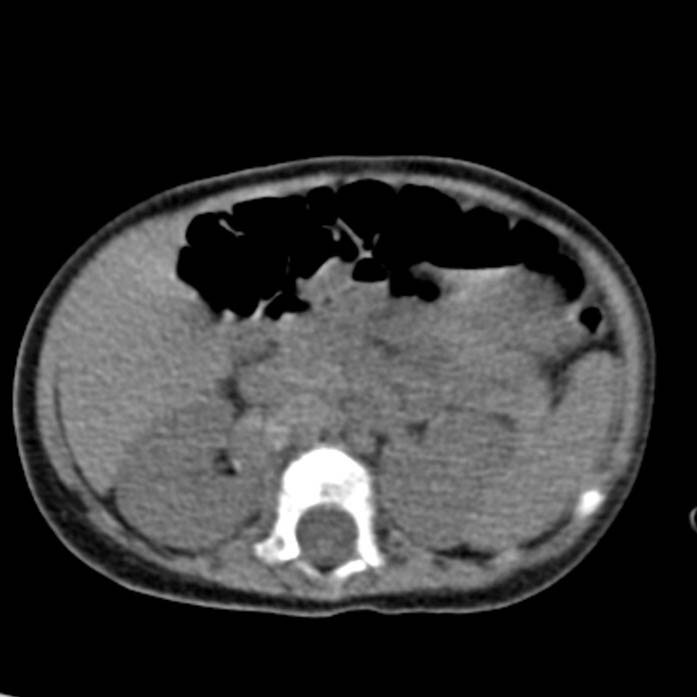 Neuroblastoma with skull metastases (Radiopaedia 30326-30960 Axial non-contrast 26).jpg