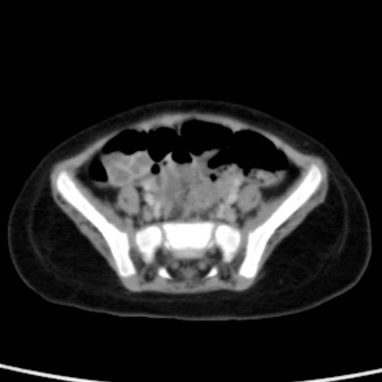 Neuroblastoma with skull metastases (Radiopaedia 30326-30960 C 47).jpg