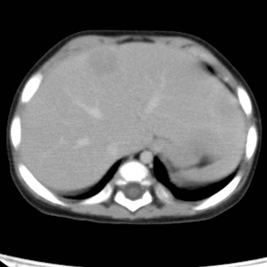 File:Neuroblastoma with skull metastases (Radiopaedia 30326-30960 C 7).jpg