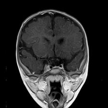 File:Neurofibromatosis type 1 (Radiopaedia 30089-30671 Coronal T1 C+ 11).jpg