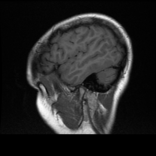 File:Neurofibromatosis type 2 (Radiopaedia 45229-49244 Sagittal T1 3).png