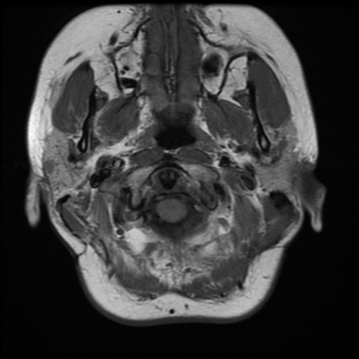 File:Neurofibromatosis type 2 (Radiopaedia 45229-49251 Axial T1 4).png
