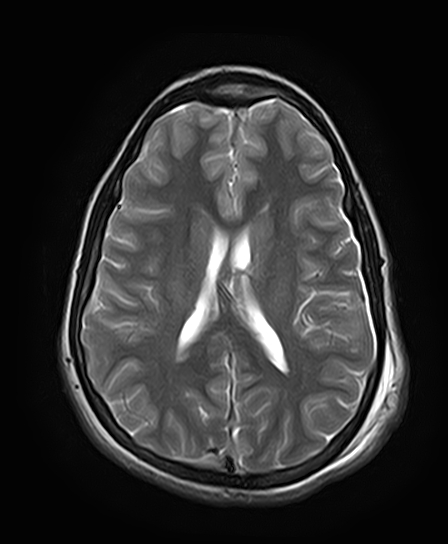 File:Neurofibromatosis type 2 (Radiopaedia 66211-75401 Axial T2 19).jpg