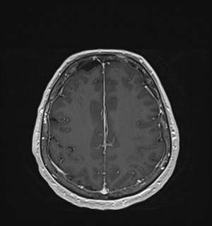 Neurofibromatosis type 2 (Radiopaedia 79097-92049 Axial T1 C+ 149).jpg