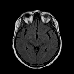File:Neurofibromatosis type 2 (Radiopaedia 8713-9518 Axial FLAIR 14).jpg