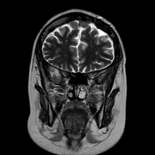 File:Neurofibromatosis type 2 (Radiopaedia 8713-9518 Coronal T2 6).jpg