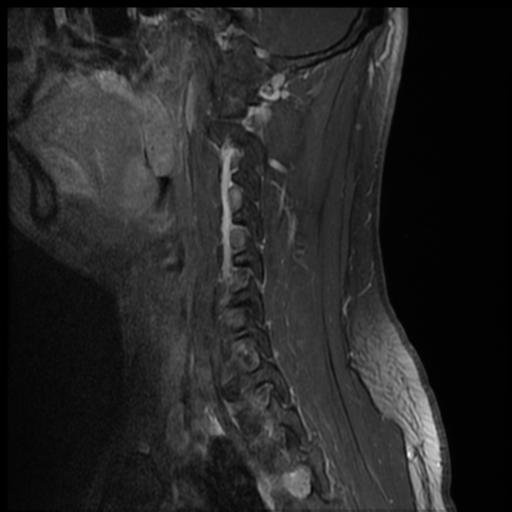 File:Neurofibromatosis type 2 (spinal manifestations) (Radiopaedia 53943-60070 G 11).png