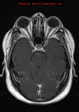 File:Neuroglial cyst (Radiopaedia 10713-11184 Axial T1 C+ 16).jpg