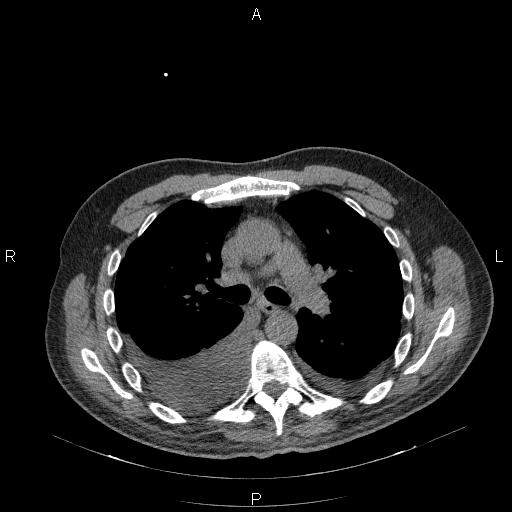 File:Non Hodgkin lymphoma in a patient with ankylosing spondylitis (Radiopaedia 84323-99624 Axial non-contrast 15).jpg