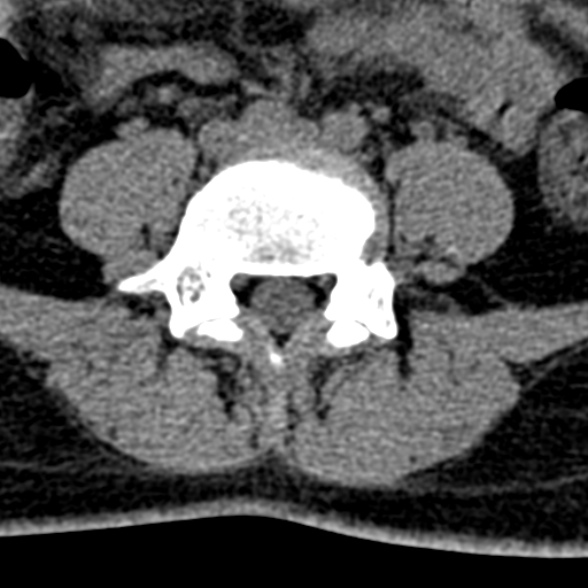 Normal CT lumbar spine (Radiopaedia 53981-60118 Axial non-contrast 74).jpg
