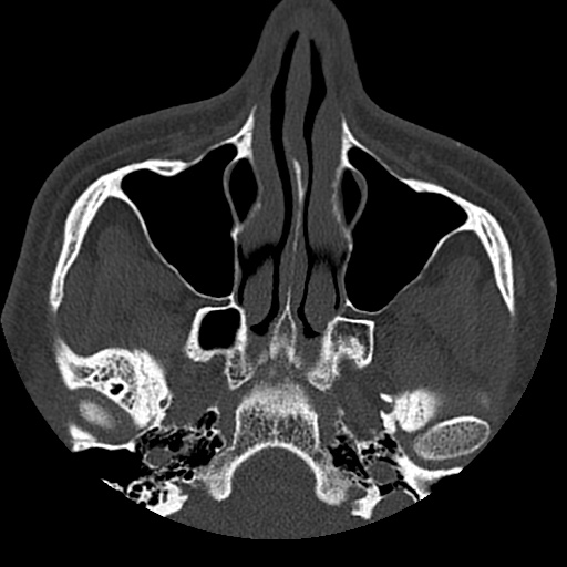 Normal CT paranasal sinuses (Radiopaedia 42286-45390 Axial bone window 74).jpg