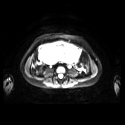 Normal MRI abdomen in pregnancy (Radiopaedia 88001-104541 Axial DWI 21).jpg
