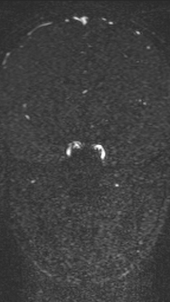 Normal MRI brain with MRV- teenager (Radiopaedia 49425-54553 Coronal MRV 121).jpg