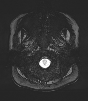 Normal MRI internal auditory canal (Radiopaedia 41613-44525 Axial SWI MIP 1).png