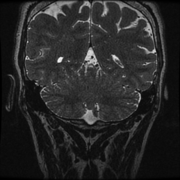 Normal MRI petrous (Radiopaedia 91317-108949 Coronal T2 110).jpg