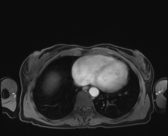 Normal adrenal glands MRI (Radiopaedia 82017-96004 K 1).jpg