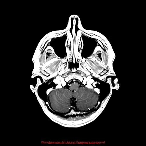 Normal adult brain MRI (non-enhanced and contrast-enhanced) (Radiopaedia 75262-86379 Axial T1 C+ 53).jpg