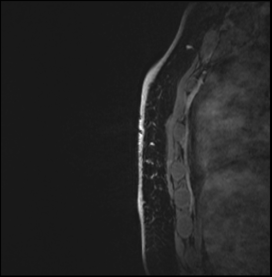 Normal breast MRI - dense breasts (Radiopaedia 80454-93850 I 161).jpg