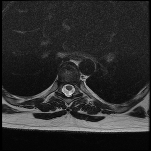 File:Normal cervical and thoracic spine MRI (Radiopaedia 35630-37156 H 27).png