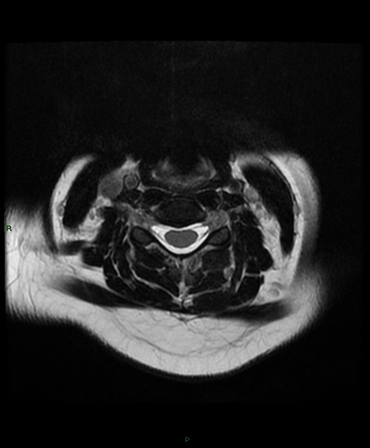 Normal cervical spine MRI (Radiopaedia 80146-93454 Axial T2 44).jpg