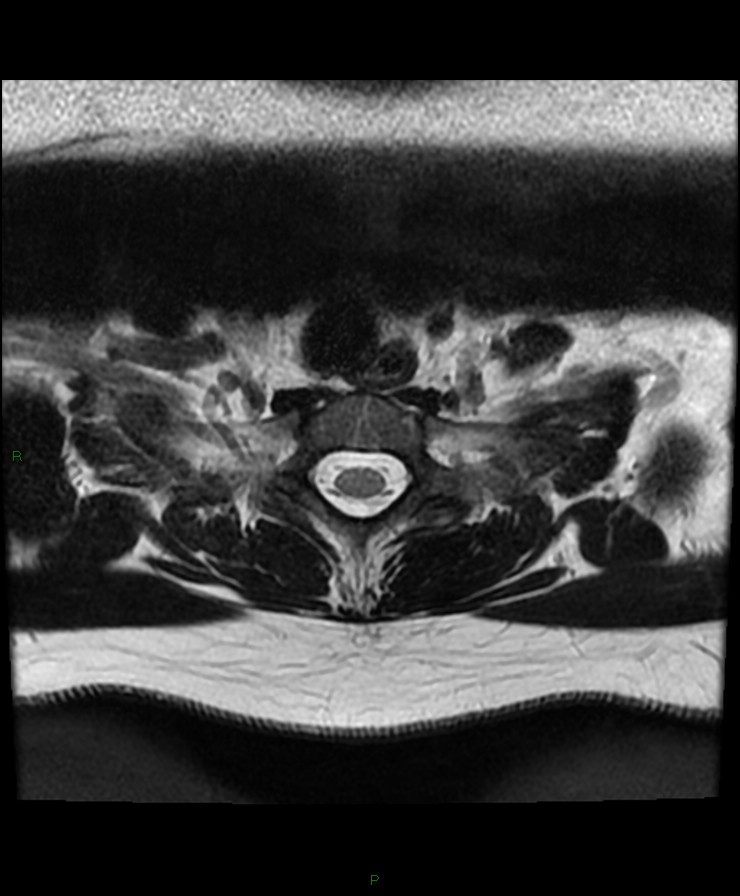 Normal cervical spine MRI (Radiopaedia 80146-93454 Axial T2 96).jpg