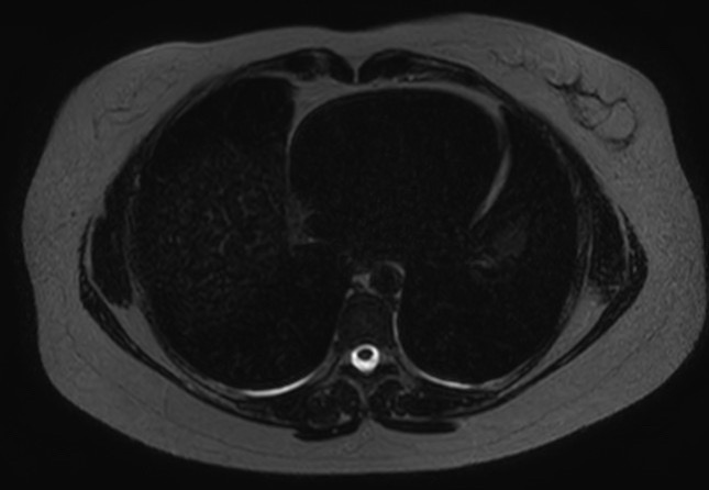 File:Normal liver MRI with Gadolinium (Radiopaedia 58913-66163 E 31).jpg