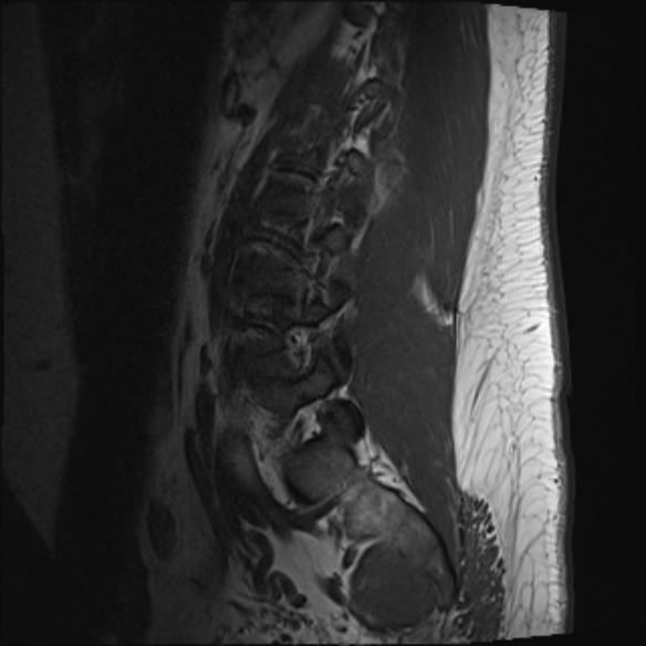 File:Normal lumbar spine MRI (Radiopaedia 47857-52609 Sagittal T1 17).jpg
