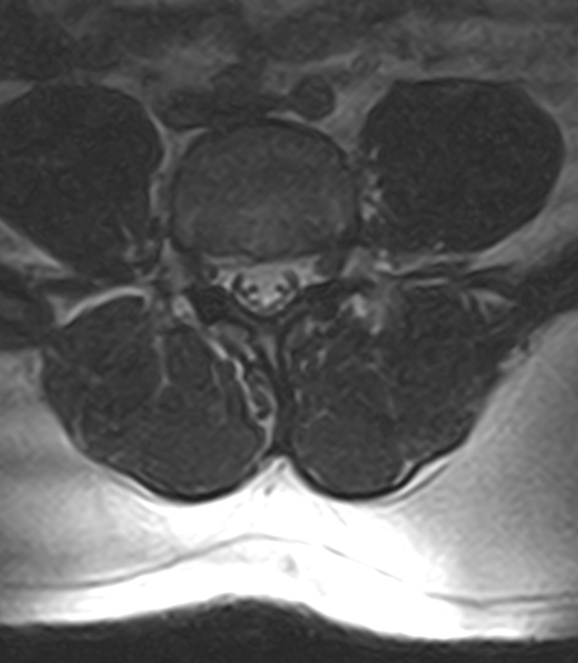 Normal lumbar spine MRI - low-field MRI scanner (Radiopaedia 40976-43699 Axial T2 70).jpg