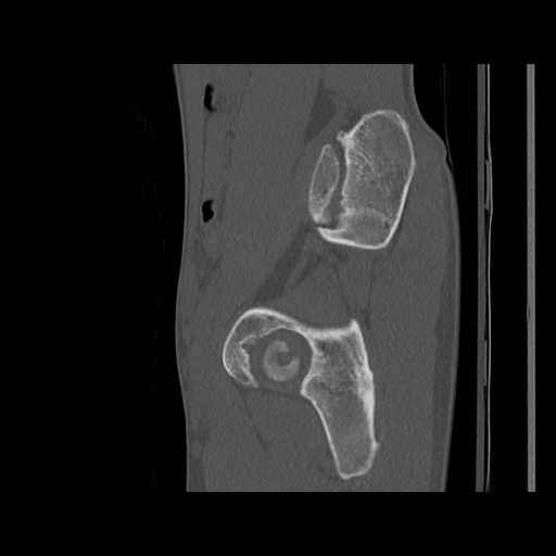 Normal pelvis (Radiopaedia 51473-57238 Sagittal bone window 104).jpg