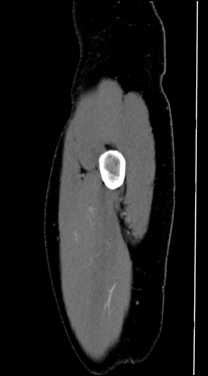 Normal pelvis CT angiogram (Radiopaedia 84966-100481 C 5).jpg