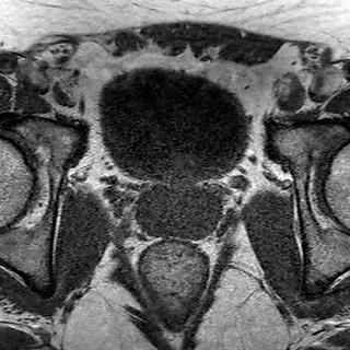 File:Normal prostate (MRI) (Radiopaedia 29986-30535 Axial T1 13).jpg