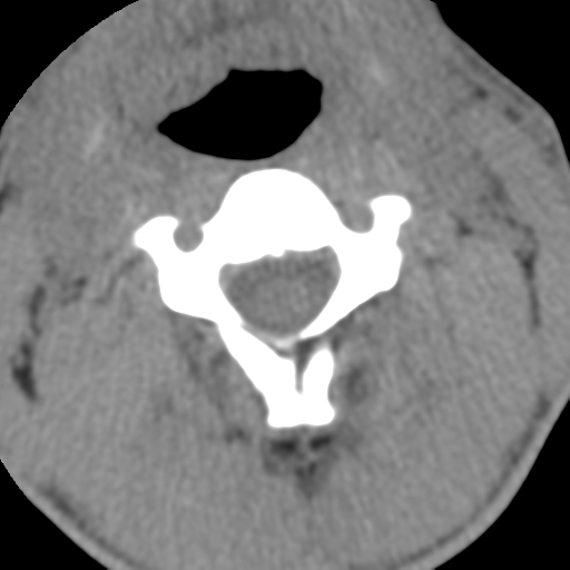 Normal trauma cervical spine (Radiopaedia 41017-43760 Axial non-contrast 25).png