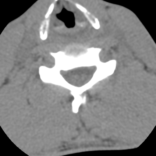Normal trauma cervical spine (Radiopaedia 41017-43760 Axial non-contrast 39).png