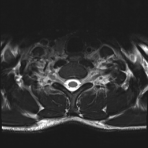 Normal trauma cervical spine (Radiopaedia 41017-43762 D 54).png