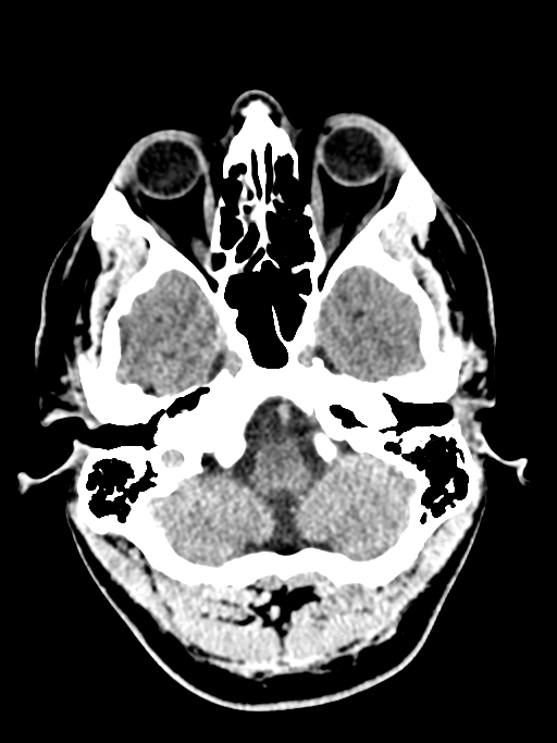 Normal trauma protocol brain and C-spine CT (Radiopaedia 83302-97709 Axial non-contrast 58).jpg