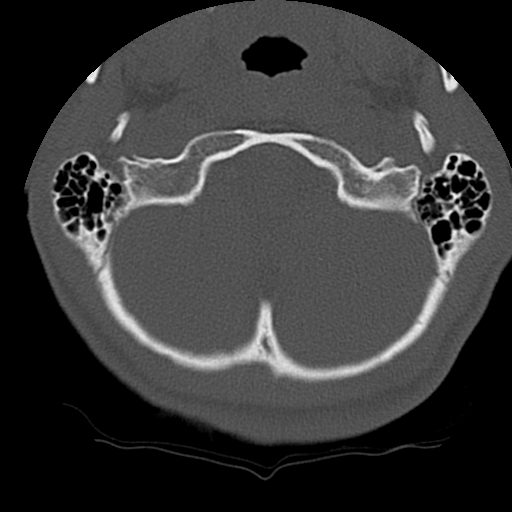 Normal trauma spine imaging (age 16) (Radiopaedia 45335-49358 Axial bone window 2).jpg